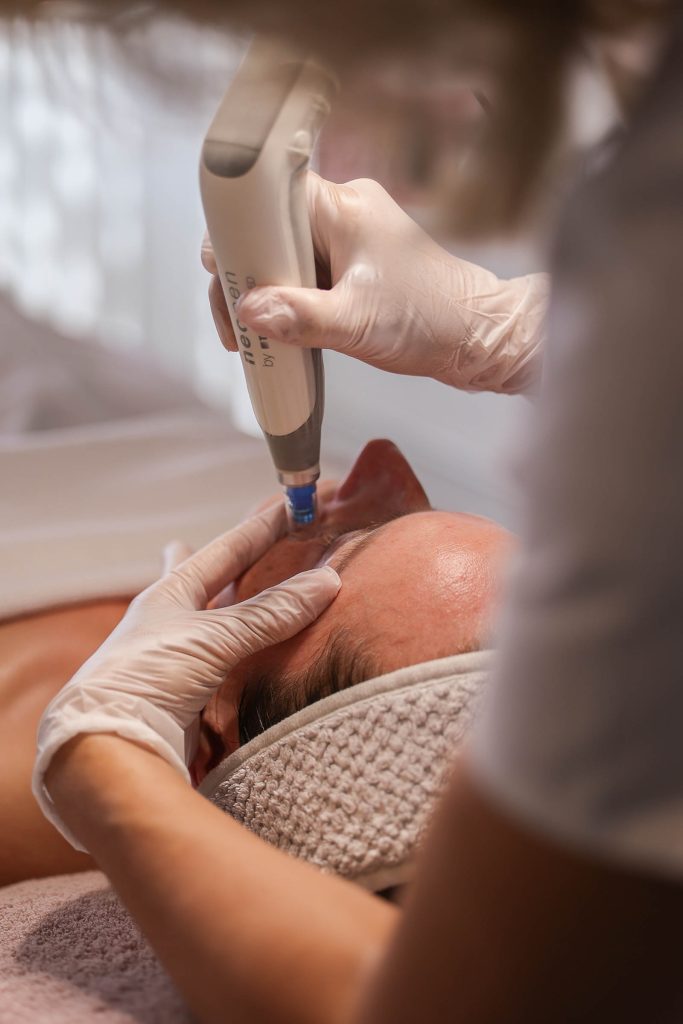 Gezichtsbehandeling voor vrouwen met Micro Needling