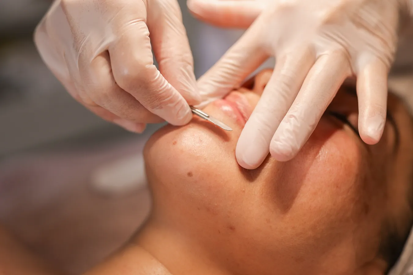 dermaplaning voor een jongere huid